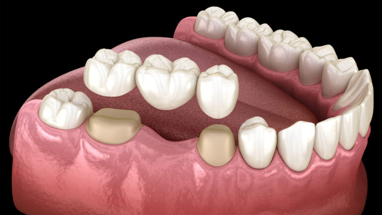 Dental Bridges