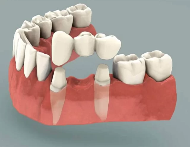 dental bridges 1 1