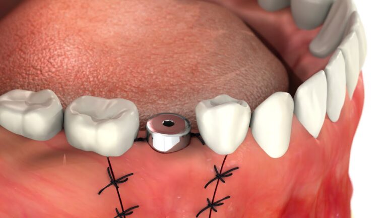 Dental Implant