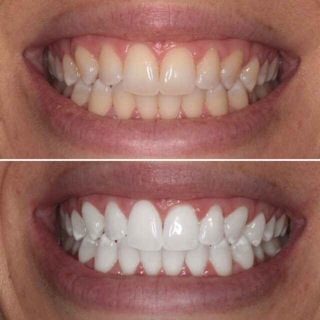 whitening22