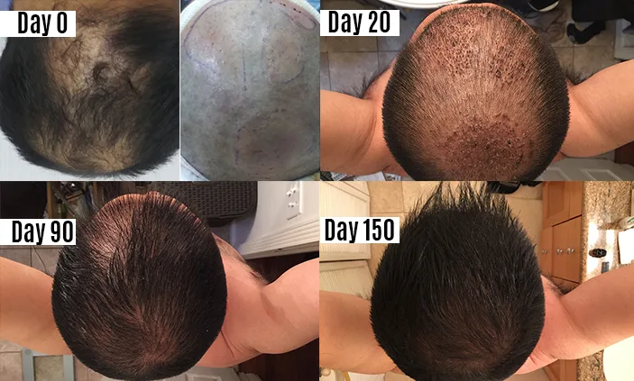 patient hairtransplant