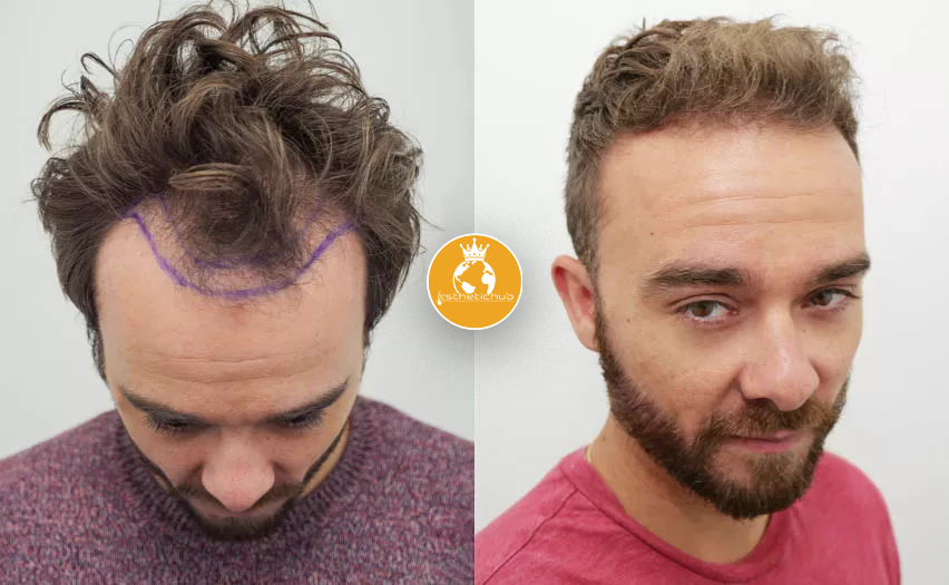 why hair transplant